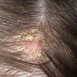 This is a bleach burn on scalp, this is a less severe case and will take weeks to heal.